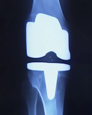 X -Ray x -Ray x -Ray of Feeld Provehis, оттан кейінгі жасанды протездермен бірге